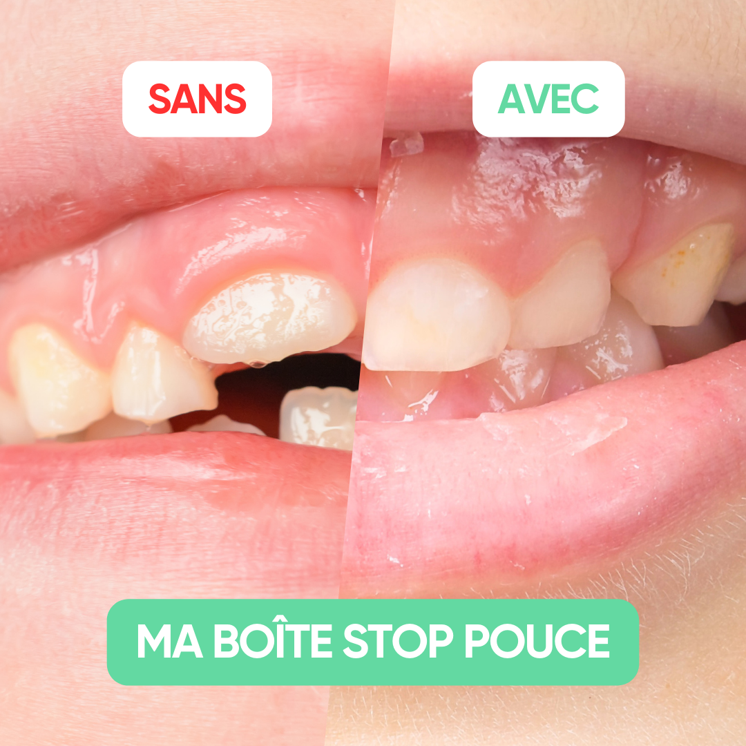 Avant et après utilisation de Ma Boîte Stop Pouce